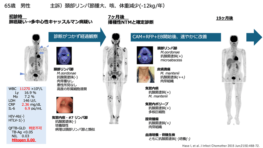図:画像、病理、培養検査でも診断困難であった症例