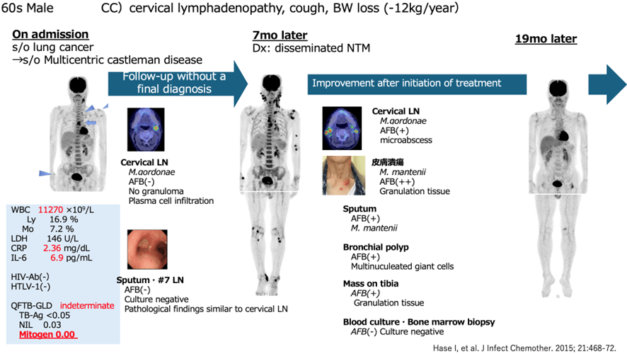 figure:A Male Patient in his 60s in whom NTM Disease was Difficult to Diagnose with Imaging, Pathology, and Culture Tests